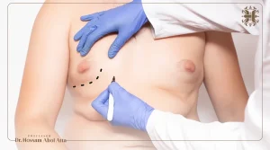 درجات التثدي عند الرجال